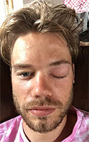 Swollen Eye